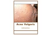 Acne Vulgaris (Dermatology)