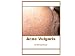 Acne Vulgaris (Dermatology)