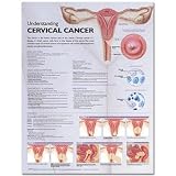 Chart -Understanding Cervical Cancer Anatomical Chart- Plastic Laminated