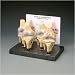 This set of four models of the knee joint includes a normal knee joint and three models illustrating the stages of osteoarthritis. Shows erosion of joint articular cartilage early to advanced and formation of bone spurs. Patient education card included. Models may be removed from base. 3 inches x 1 3/4 inches x 5 1/2 inches.