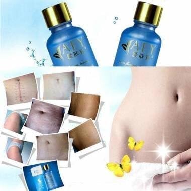 AFY Stretch Obesity Marks Removal Essential Oil Postpartum Recovery by MK Bang