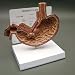 Stomach Cancer Anatomical Model