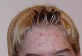 41bT6X8XATL. SL160  The Acne Zapper