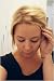 Alopecia Areata  Questions and Answers about Alopecia Areata