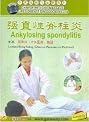 Ankylosing Sphondylitis (Chinese Medicine Massage Cures Diseases in Good Effects)