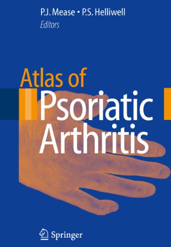 psoriatic arthritis