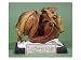 Model of a Tumour of the Left Ventricle, 1799 Stretched Canvas Poster Print