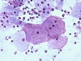 Gardnerella Vaginalis Clue Cells Pap Smear X10 Photographic Poster Print, 24x18