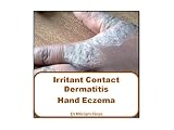 Irritant Contact Dermatitis and Hand Eczema (Dermatology Atlas) 41e8EzdQ1oL. SL160 Irritant Contact Dermatitis and Hand Eczema (Dermatology Atlas)