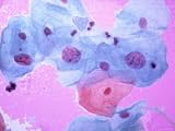 Pap Smear Squamous Cells Intra-Epithelial Lesion Photographic Poster Print, 24x32