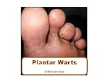 Plantar Warts (Dermatology)