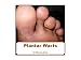 Plantar Warts (Dermatology)