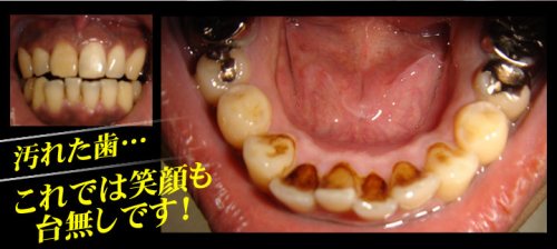 Cover image : 歯科医専用ホワイトニング・歯のクリーニング液！『歯科医専用ホワイトニング ビームスリック トゥースプロフェッショナル』