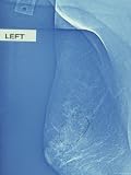 Mammogram Breast Cancer Photographic Poster Print, 12x16