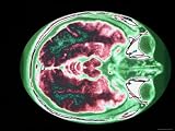 Magnetic Resonance Imaging Head at Level of Orbits Photographic Poster Print, 40x30