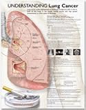 Understanding Lung Cancer Anatomical Chart- paper unmounted