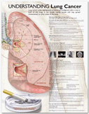 Understanding Lung Cancer Anatomical Chart- paper unmounted