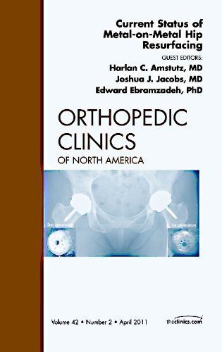 Current Status of Metal-on-Metal Hip Resurfacing, An Issue of Orthopedic Clinics, 1e (The Clinics: Orthopedics) by Harlan Amstutz MD (2011-05-11)