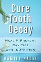 Cure Tooth Decay: Heal And Prevent Cavities With Nutrition - Limit And Avoid Dental Surgery and Fluoride