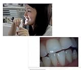 20mp Dental Camera with Waterproof, Intra-oral, USB