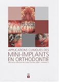 Applications cliniques des mini-implants en orthodontie