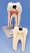 2 Part Lower Twin-Root Molar showing caries attack