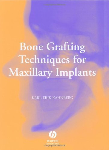 Bone Grafting Techniques for Maxillary Implants On Sale