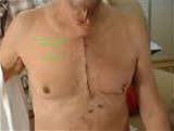 Patient's View of Open Chest Surgery