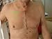 Patient's View of Open Chest Surgery