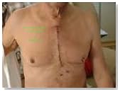 Patient's View of Open Chest Surgery