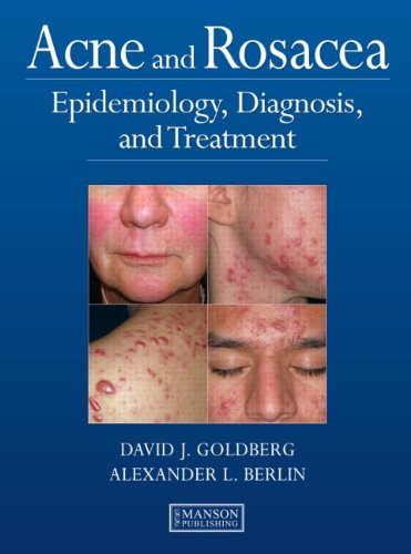 acne and rosacea epidemiology diagnosis and treatment