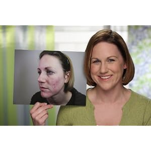 ANSR Acne Care Starter Kit With Handheld Phototherapy Device And Acne Topicals