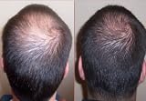 High Quality hair loss treatment (15% minoxidil + 5% Azelaic Acid) High Quality hair loss treatment (15% minoxidil + 5% Azelaic Acid)