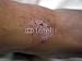 Wallmonkeys Peel and Stick Wall Decals - Eczema - 