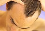 Natural Hairloss Remedies