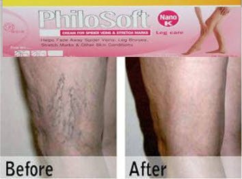 treatment for spider veins