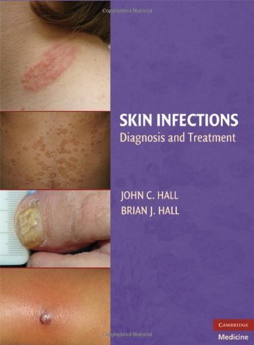 Skin Infections: Diagnosis and Treatment 1st Edition by Hall, Brian J. published by Cambridge University Press Hardcover