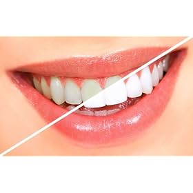 At Home Teeth Whitening Pen *Turns your teeth many shades whiter without the expense!*