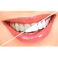 At Home Teeth Whitening Pen *Turns your teeth many shades whiter without the expense!*