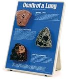 Death of a Lung Model; Normal and Diseased; Depicts Emphysema and Cancer