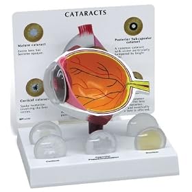 Click here to buy Cataract Eye Model.