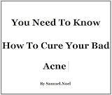 You Need To Know How To Cure Your Bad Acne