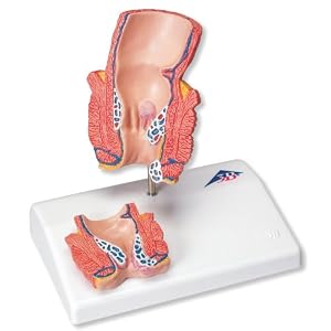 3b Scientific K27 Hemorrhoid Model 3b Scientific K27 Hemorrhoid Model