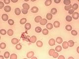 Babesiosis Caused by Parasites in Blood Photographic Poster Print, 40x30