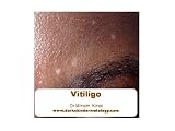 Vitiligo (Dermatology)