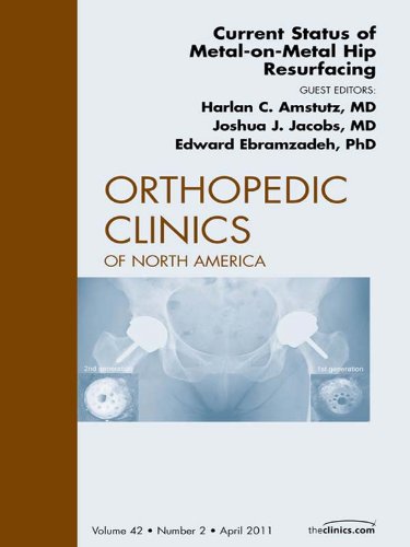 Current Status of Metal-on-Metal Hip Resurfacing, An Issue of Orthopedic Clinics (The Clinics: Orthopedics)