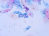 Koilocytes Altered by Human Papillomavirus Photographic Poster Print, 24x18