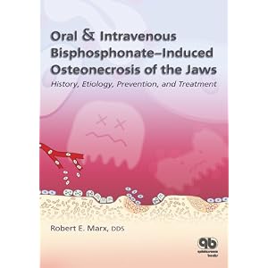 Click here to buy Oral and Intravenous Bisphosphonate-Induced Osteonecrosis of the Jaws: History,... by Robert E. Marx.