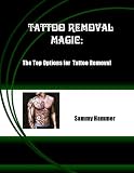 Tattoo Removal Magic: The Top Options for Tattoo Removal