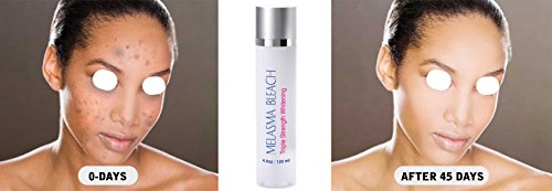 Melasma Bleach Triple Strength Whitening Emulsion 120ml. A Strong Bleaching Cream To Choose When Sun UV Induced Melasma is Present.